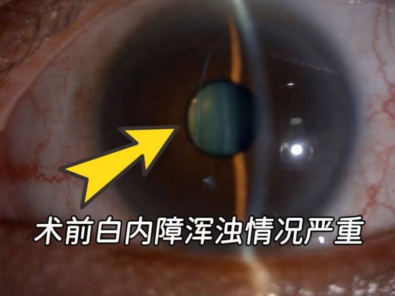 超高度近视遇上白内障，佛山爱尔何锦贤院长“飞白+三焦点”助54岁大叔重获高清视界(图1)