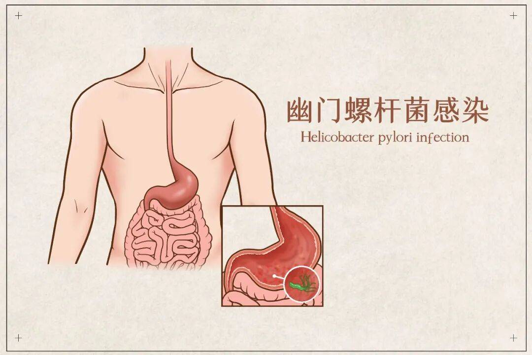 查出幽门螺杆菌怎么办？这份“应对宝典”请收好