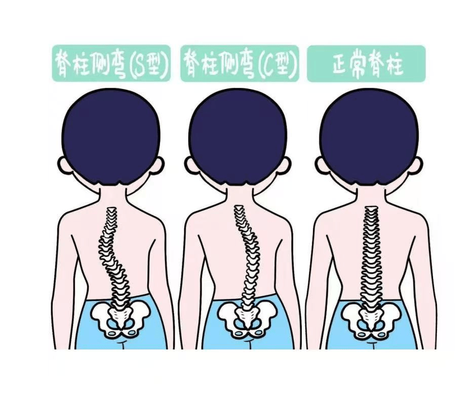 孩子坐姿总歪斜？高低肩明显？警惕青少年脊柱侧弯正在悄悄“侵蚀”健康