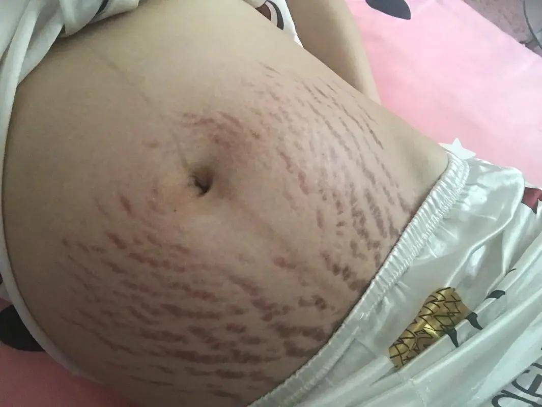 哪些人容易长妊娠纹？妊娠纹防比治管用一万倍！