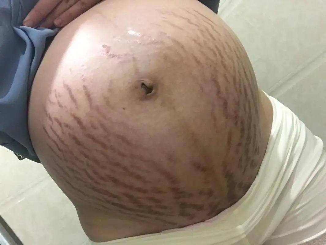 哪些人容易长妊娠纹？妊娠纹防比治管用一万倍！