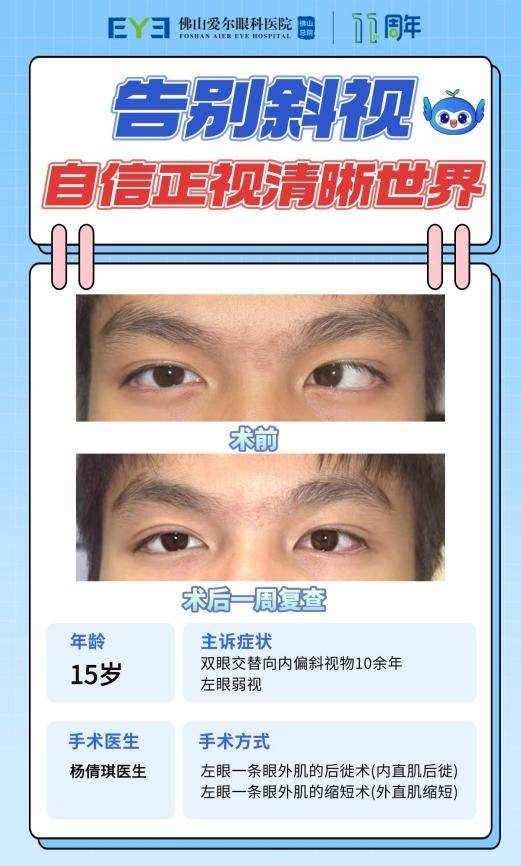15岁少年被斜视困扰十年!经佛山爱尔眼科总院杨倩琪医生手术+视觉训练重拾自信(图2) 15岁少年被斜视困扰十年!经佛山爱尔眼科总院杨倩琪医生手术+视觉训练重拾自信(图2)