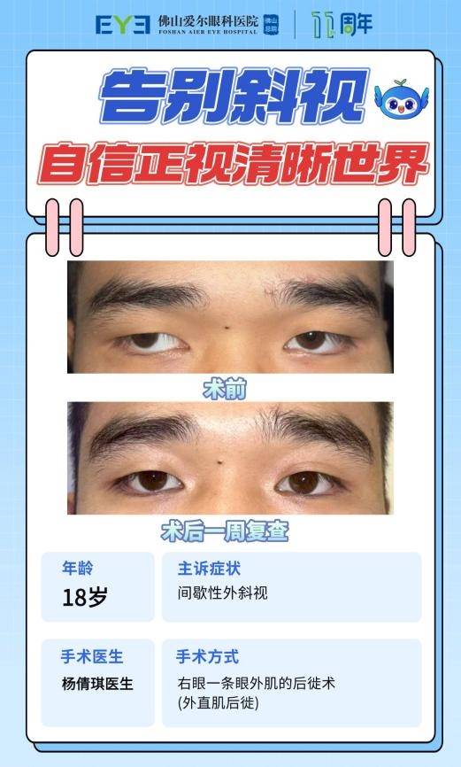 “眼位跑偏”到“正视人生”——佛山爱尔杨倩琪助18岁少年暑期成功矫正斜视(图1)