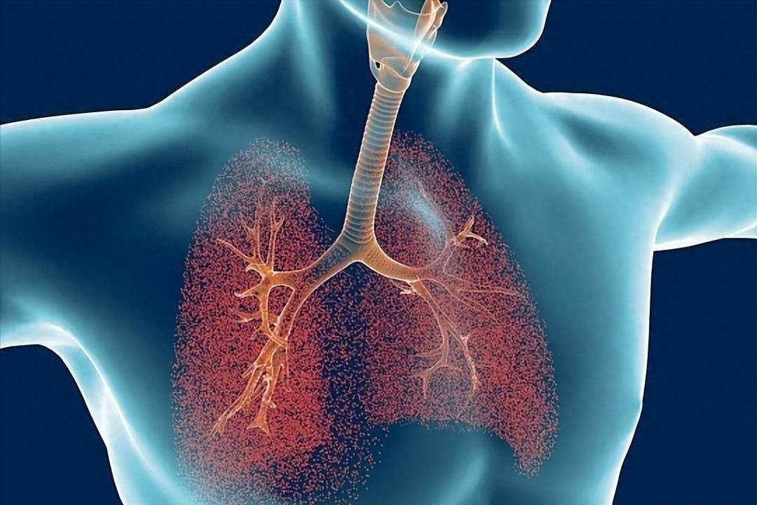 原创            体检报告上查出肺结节，是得癌了吗？错，出现4类症状别拖延
