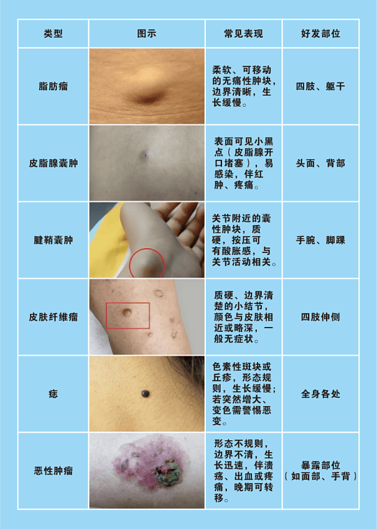 小硬块不痛不痒更危险？上海朱吉：先别慌，这样查