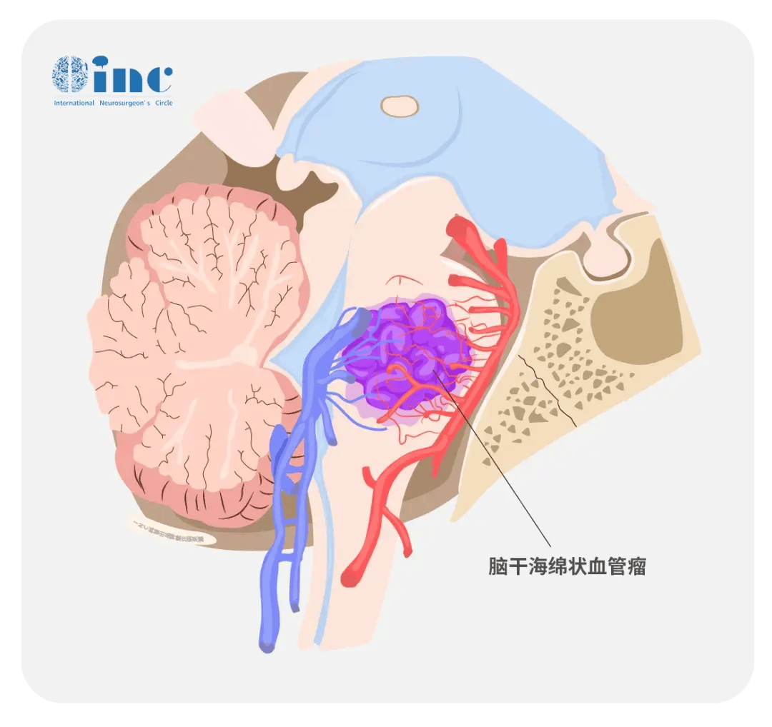 孩子一切正常，可医生却说她的脑干紧急出血！