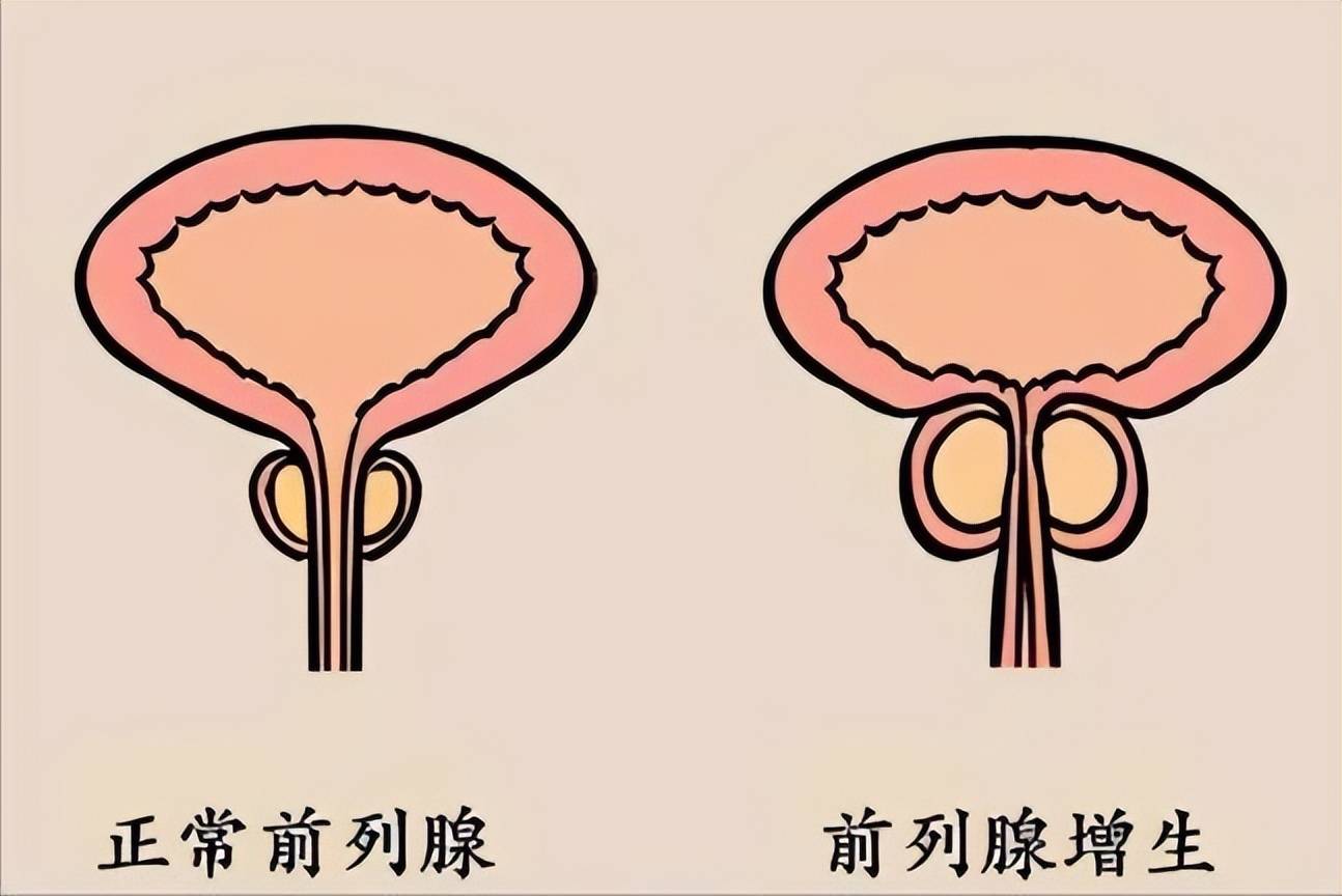 北京何峰：开会憋不住尿总找厕所？前列腺问题不只在夜里