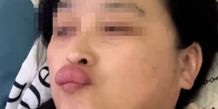 爱的代价？姥姥亲吻婴儿脚丫后嘴唇肿成香肠