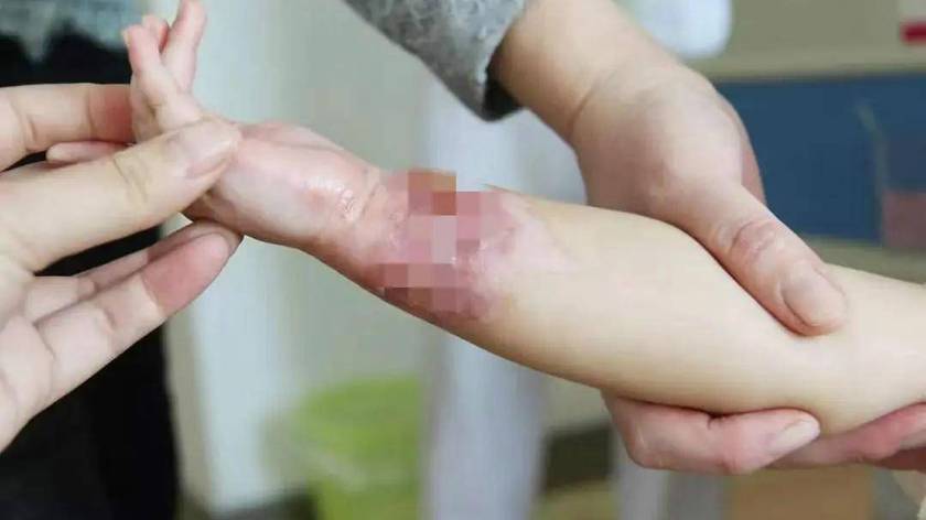 4岁儿子被100度开水烫伤，妈妈的急救措施，医生称赞