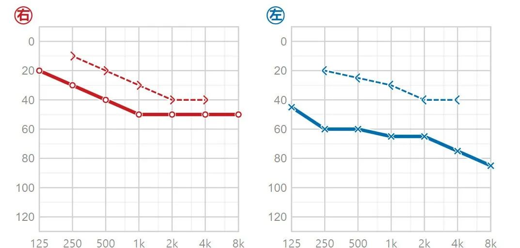 如何看懂聽力報告單?(純音測聽)_聽閾_損失_符號