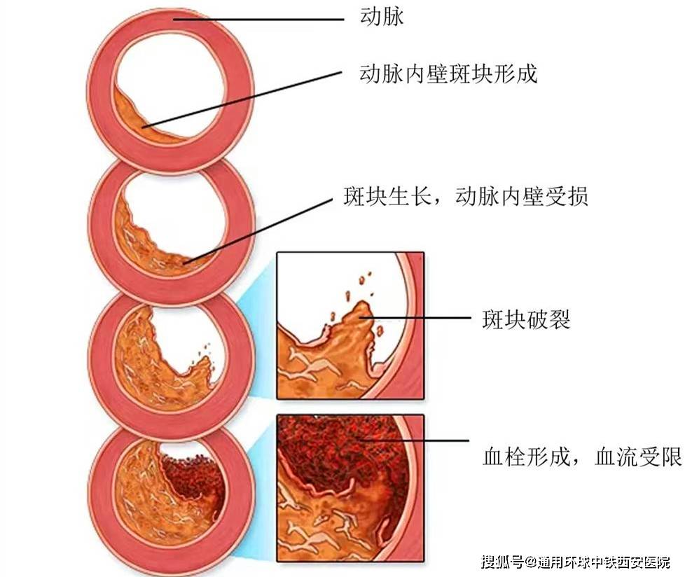 颈动脉狭窄程度图片