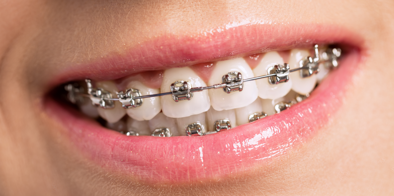 b:金属自锁牙套优点:普通牙套采用普通金属托槽制作,具有体积小,表面