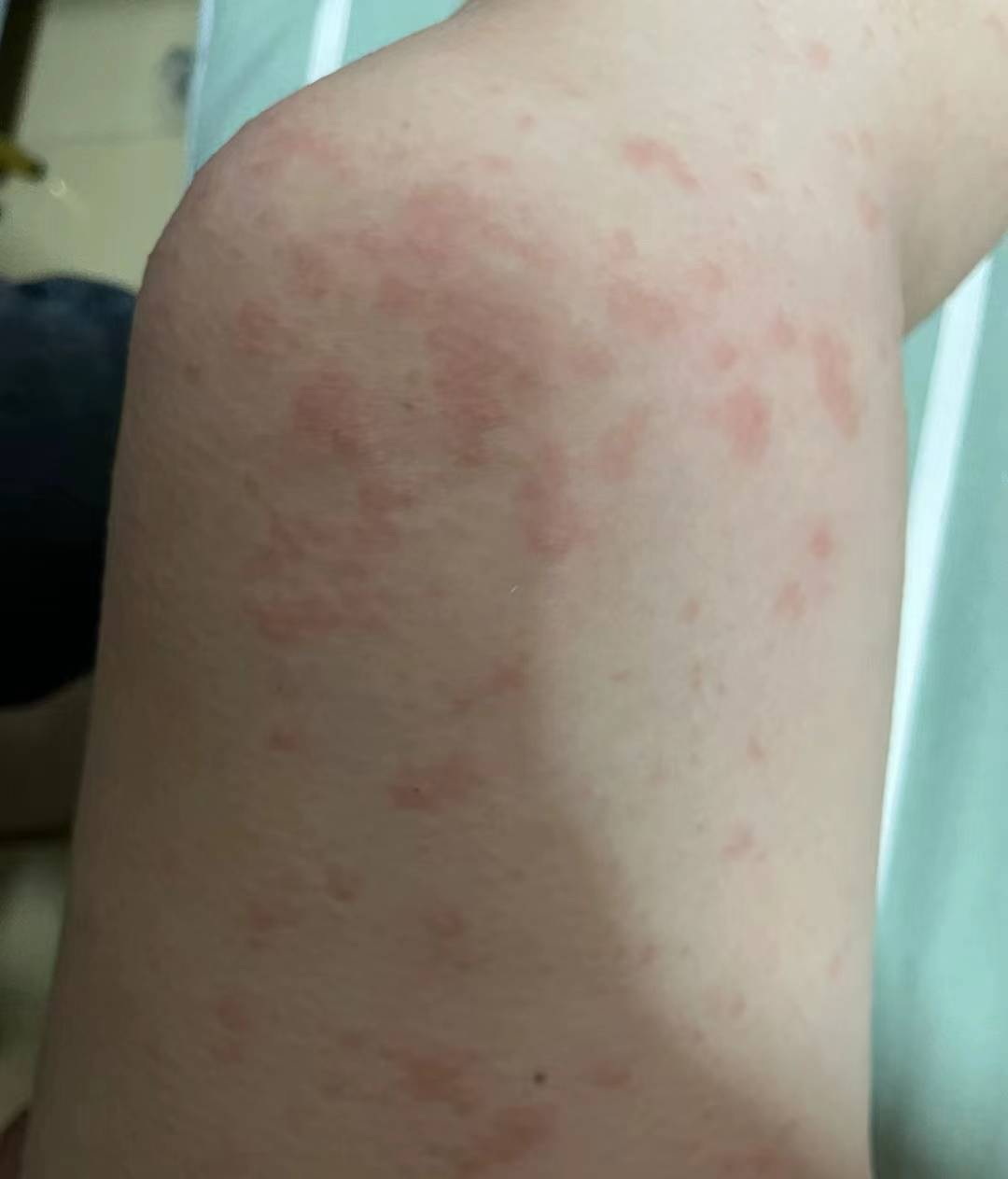 腿上红疹瘙痒反复不断?坚持三个止痒步骤,30天效果肉眼可见!