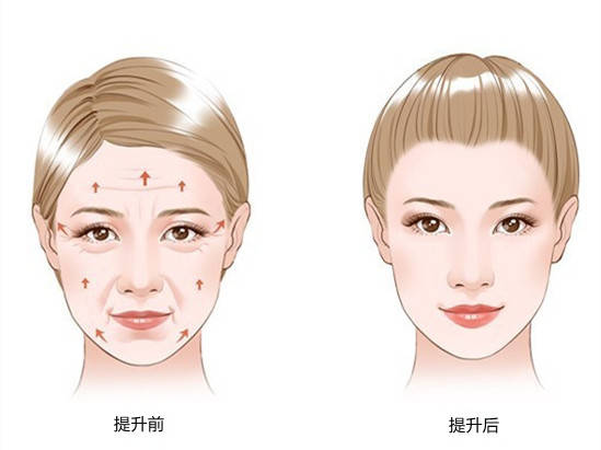 这种方式的手术切口,主要是在耳朵上方靠近发际线的地方做1