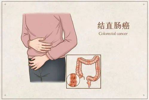 福州御和堂石毓斌:结直肠癌有这些症状!中医如何缓解?