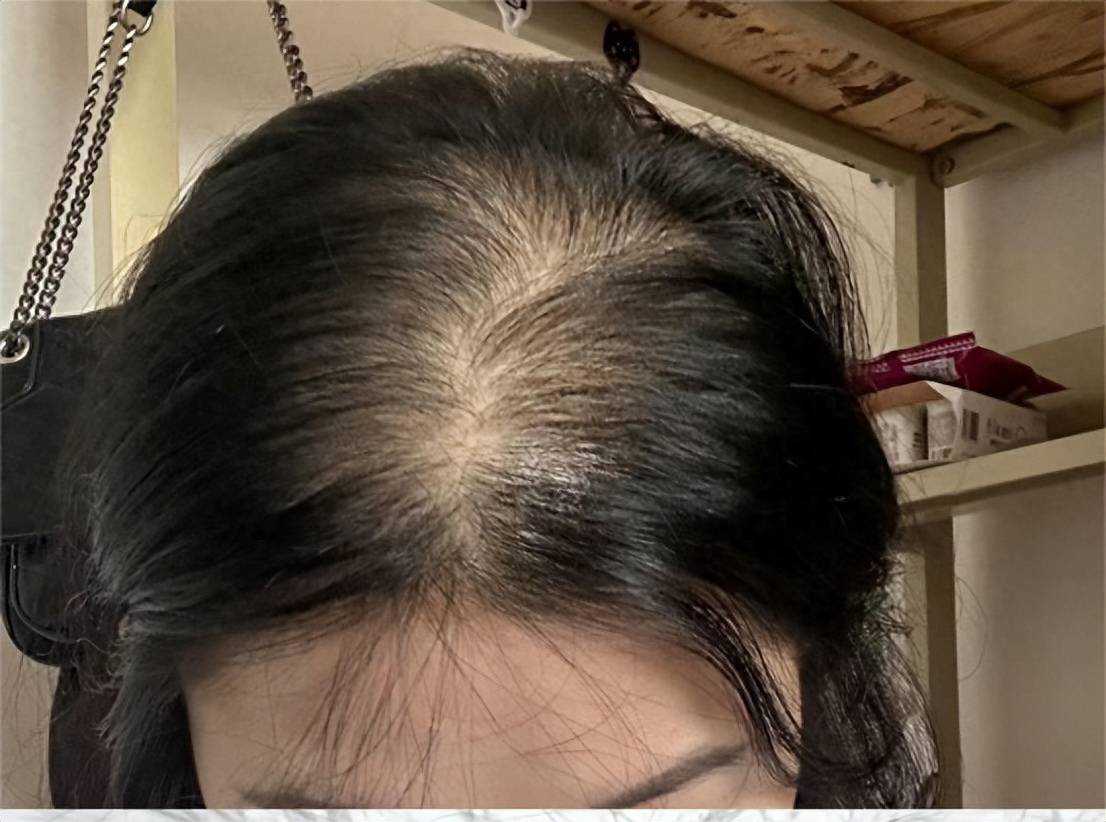头发一梳落一大把?过来人分享育发宝典!短短45天新发炸满头!