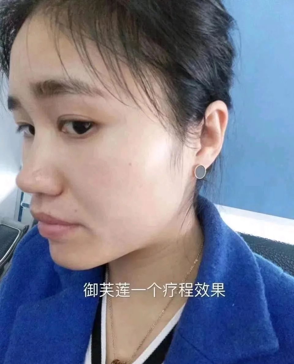 御芙莲护肤知识之痘痘篇