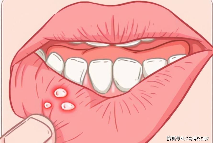 1年口腔溃疡大于3次或者是白塞病!—义乌口腔护理_症状_维生素_方面