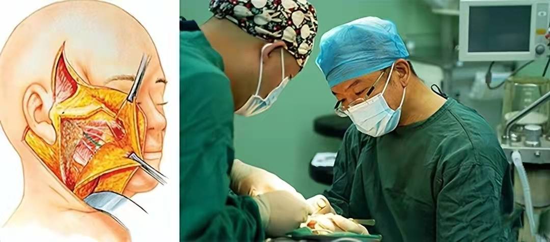 医生坦白讲:拉皮手术背后,那些你不可不知的"后遗症"