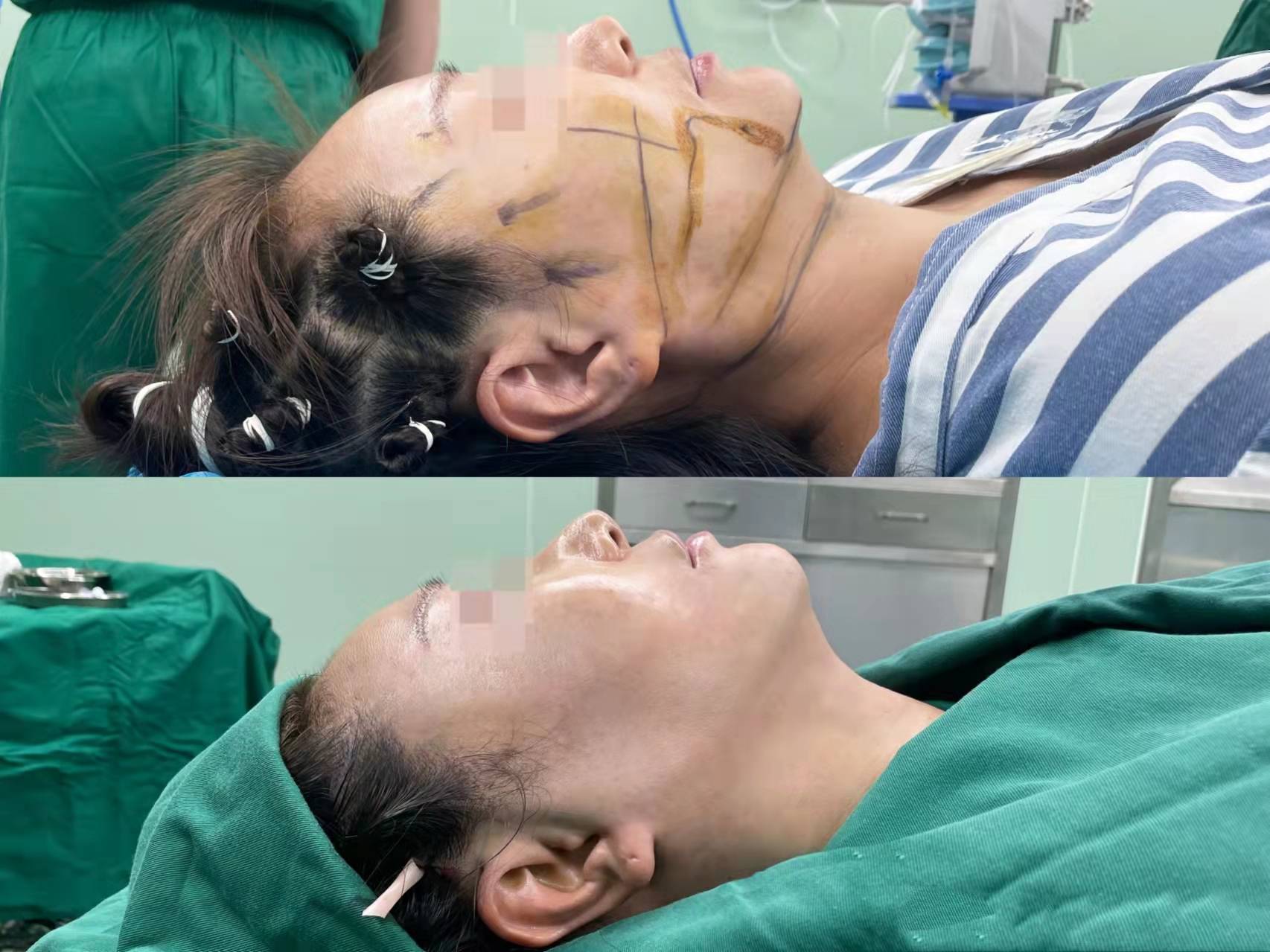 同样做拉皮手术,为什么你做的拉皮效果不好?