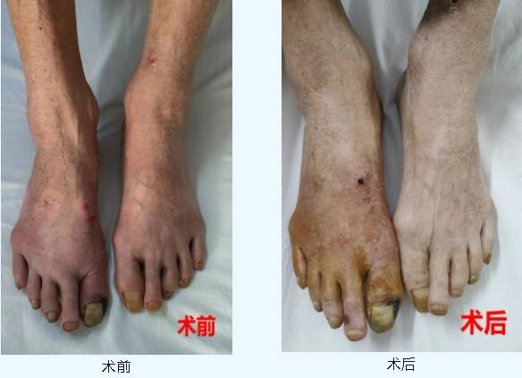 苍梧县人民医院运用微创介入技术成功救治下肢动脉硬化闭塞症患者