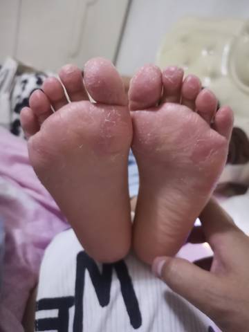 宝宝也会得脚气宝妈们必学的三个去除脚气方法还宝宝健康脚丫