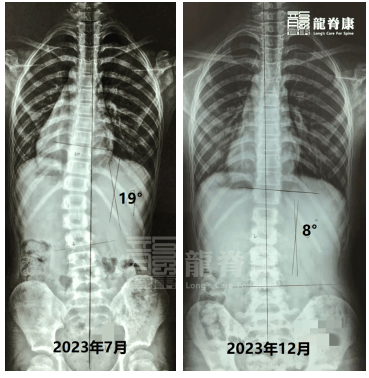 公益龙脊康之脊柱侧弯筛查进康乐中学助力青少年健康成长