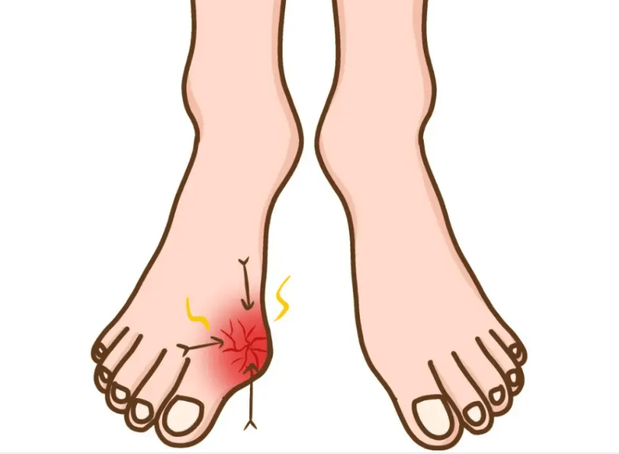 出门旅行后做好这几点 痛风不发作