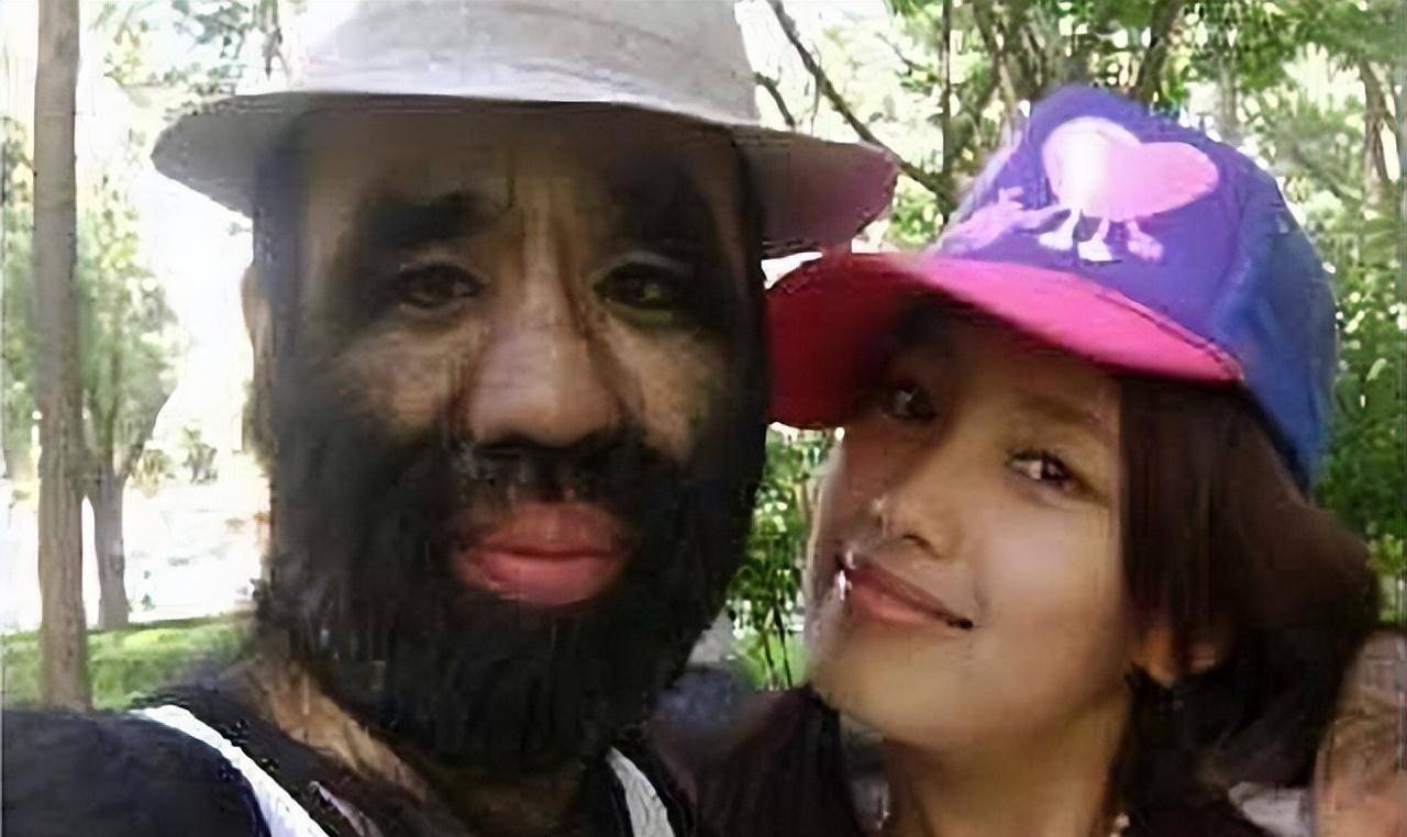 当时,国内已经有不少"毛人"做了脱毛手术,许多医院也向于震寰发来邀请