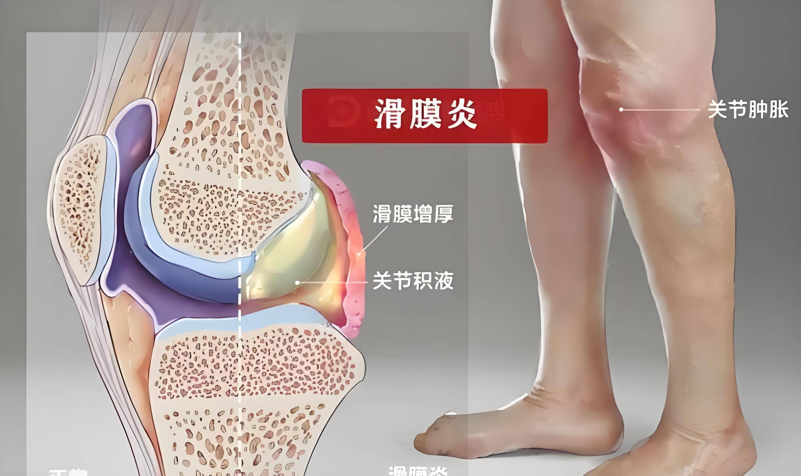 膝盖积液图片对比图片