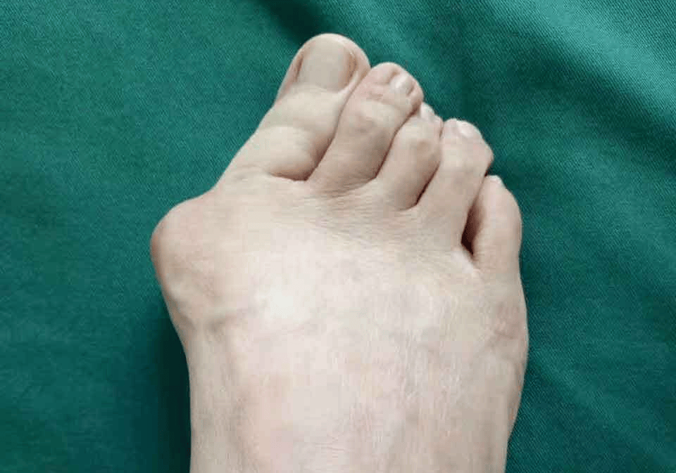 顺义治大脚骨(拇外翻)可以去哪家医院