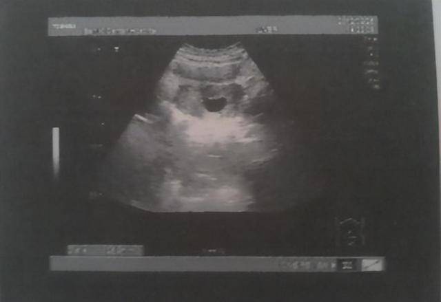刚怀孕四个月,公公婆婆就旁敲侧击,让她去给胎儿做鉴定,男孩就留下来