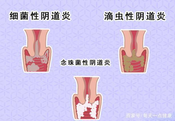 其实对于女性而言,应该改掉一些不良的行为和习惯,能有效防治阴道炎症