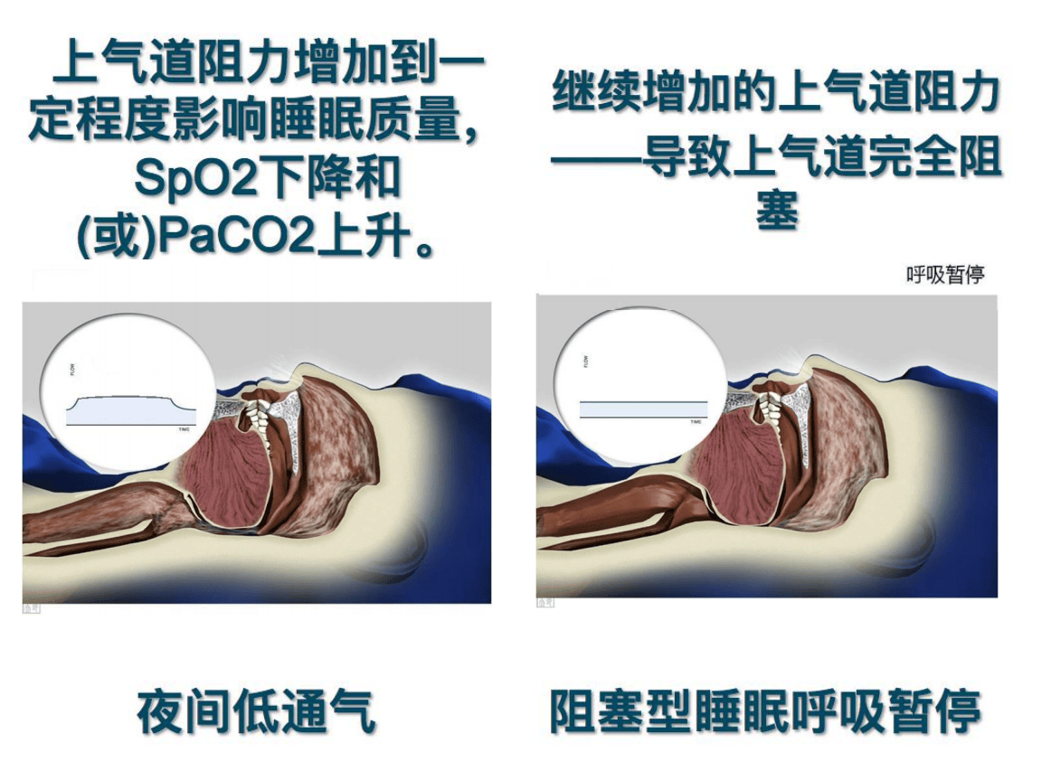 夹鼻式阻鼾器原理图片