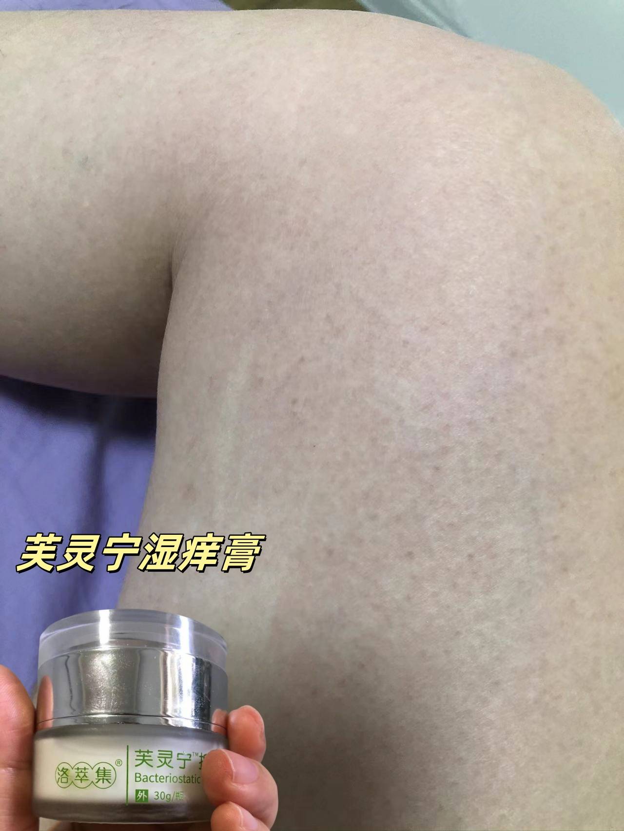 湿疹的黑印子多久能消图片