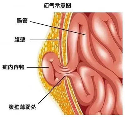 腹股沟斜疝怎么治疗图片