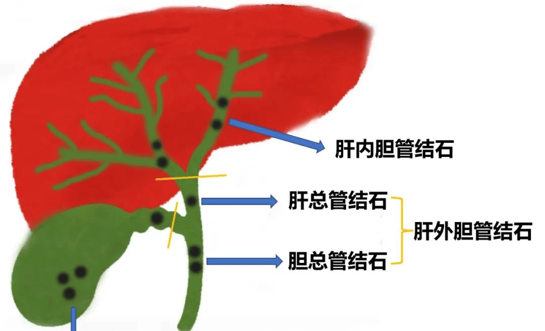 胆总管肝固有动脉图片