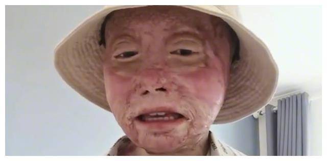 乔燕:因汽车自燃被烧伤,全脸毁容双手截肢,928天后涅槃重生