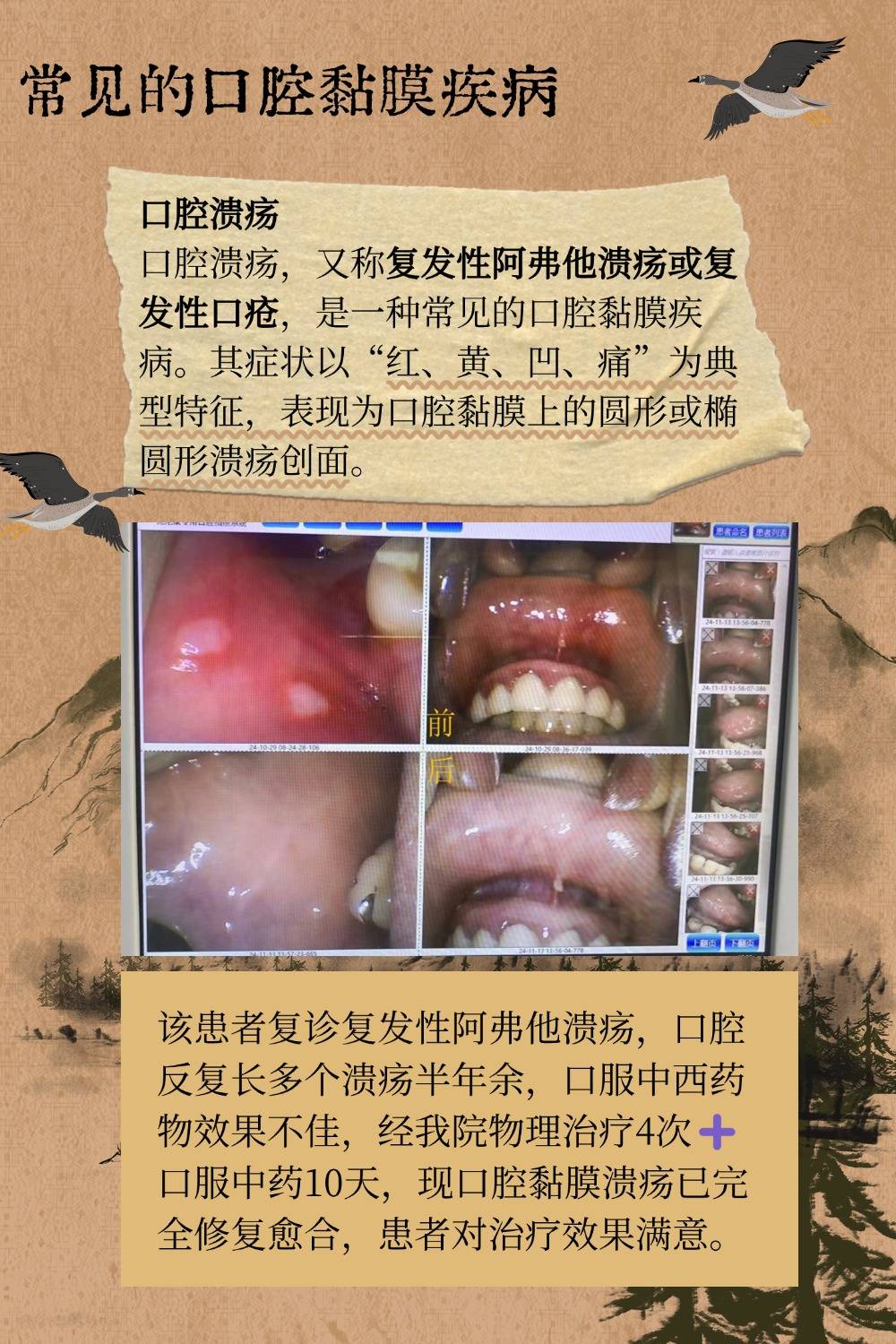 常见的口腔黏膜疾病你知道几个?