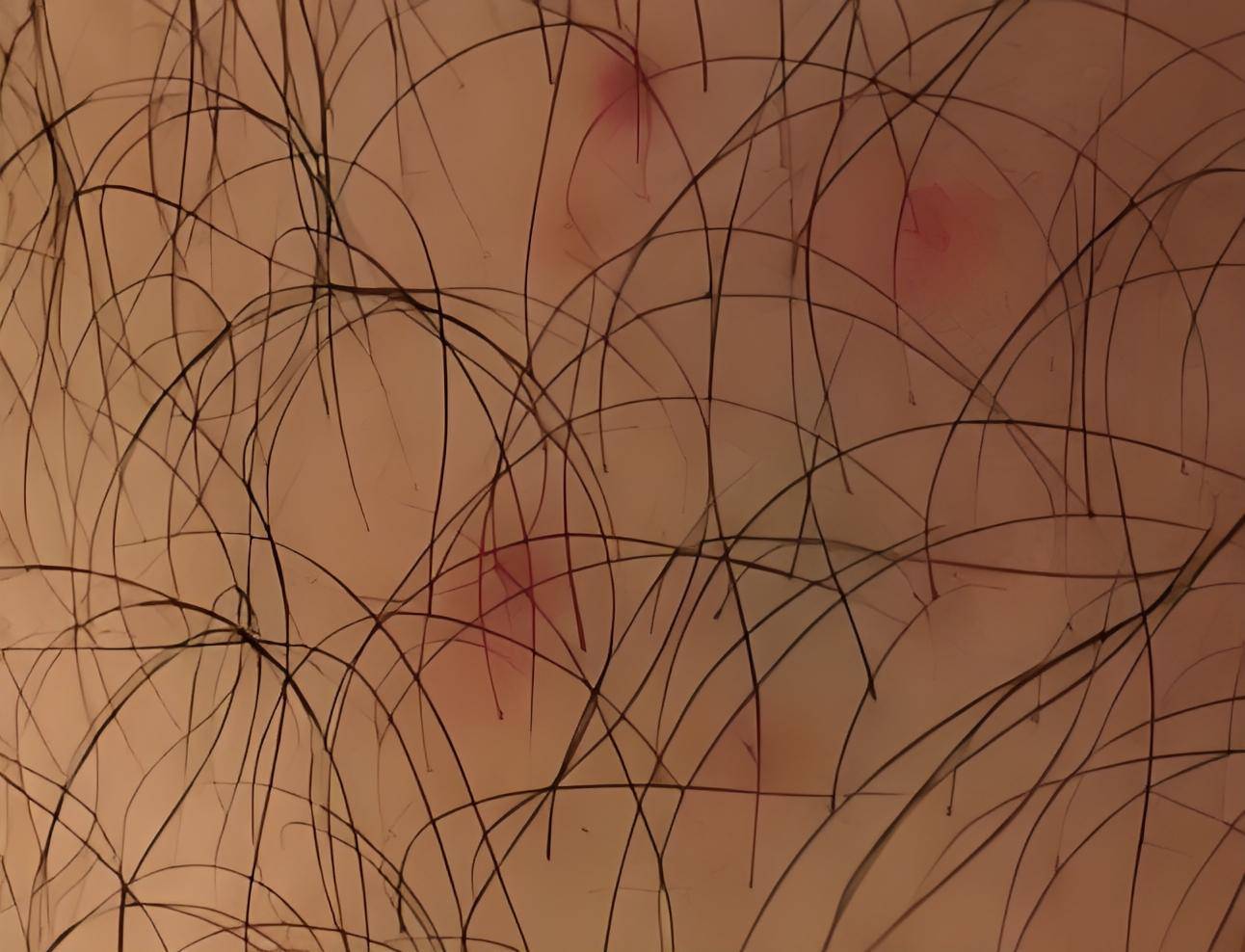 宿迁楚街皮肤病医院丨毛囊炎来袭,专家教你如何科学防护!