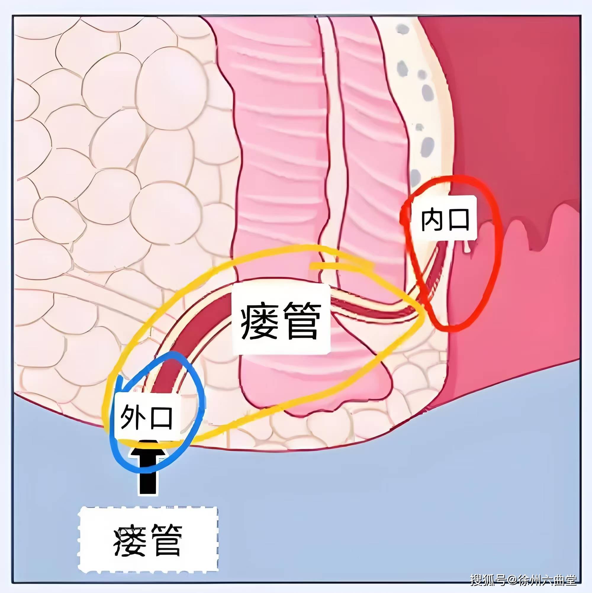 肛瘘瘘管位置图片