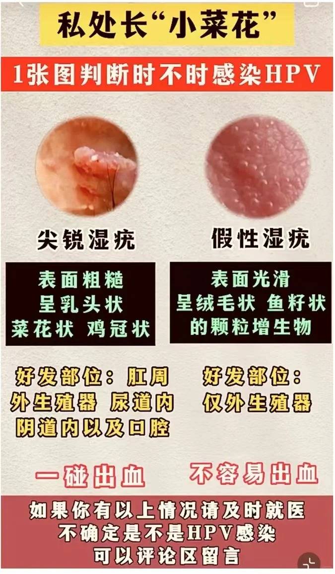 尖锐湿疣