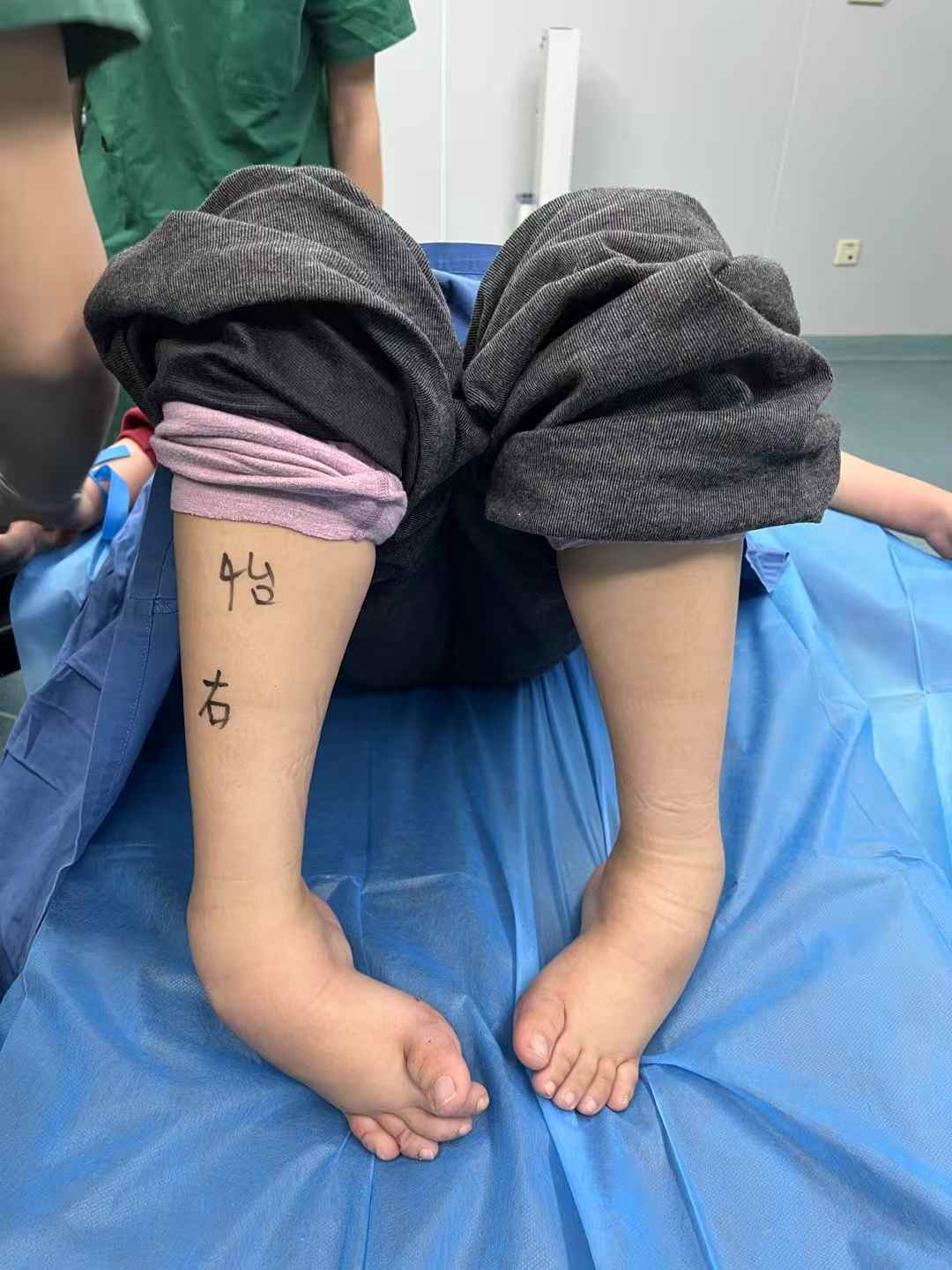 9岁女孩足内翻:20天中医无创矫正,美脚归来笑颜开