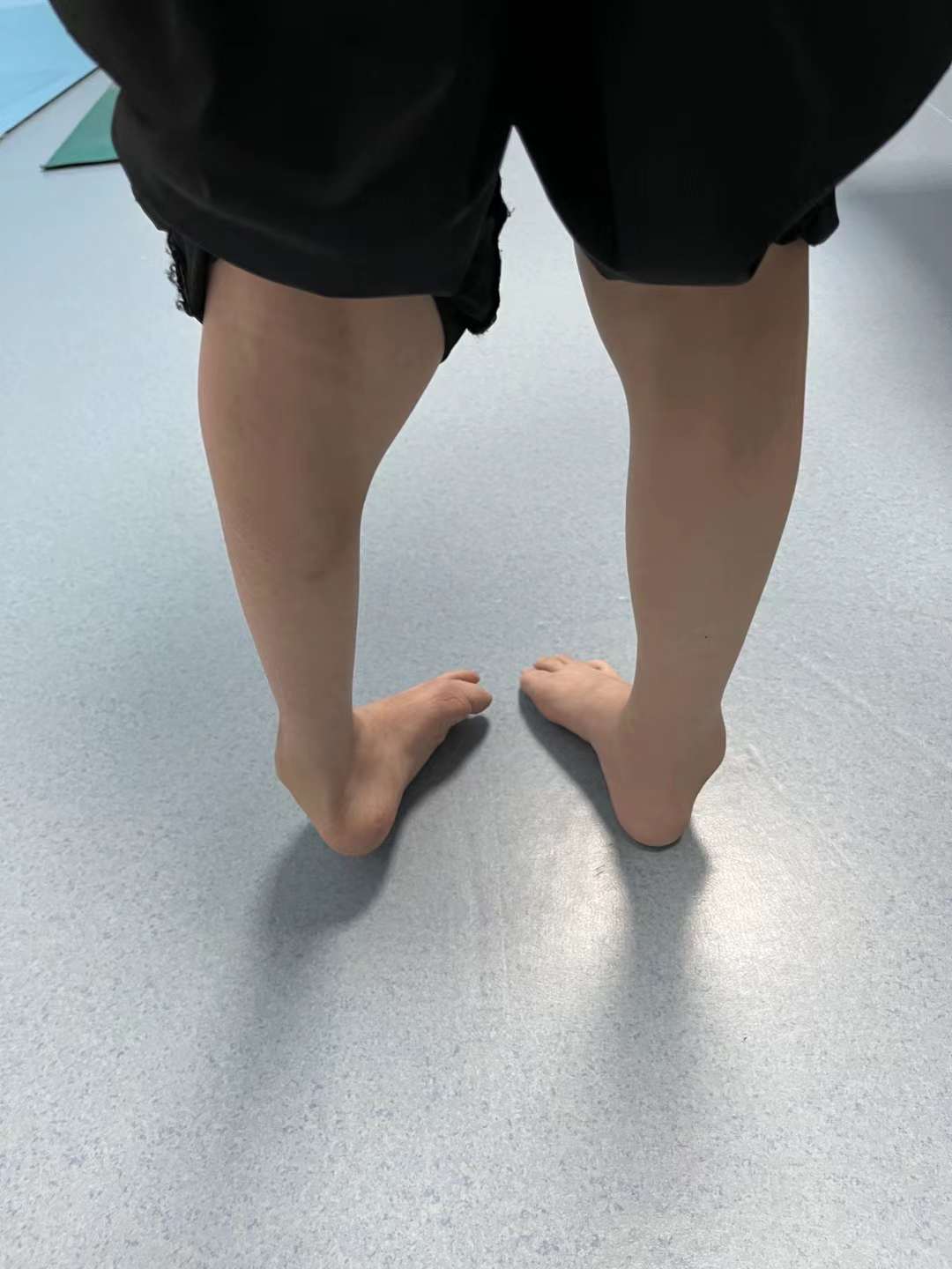 马蹄内翻足男孩的"奔跑梦":胡霞中医无创非手术技术改写畸形命运