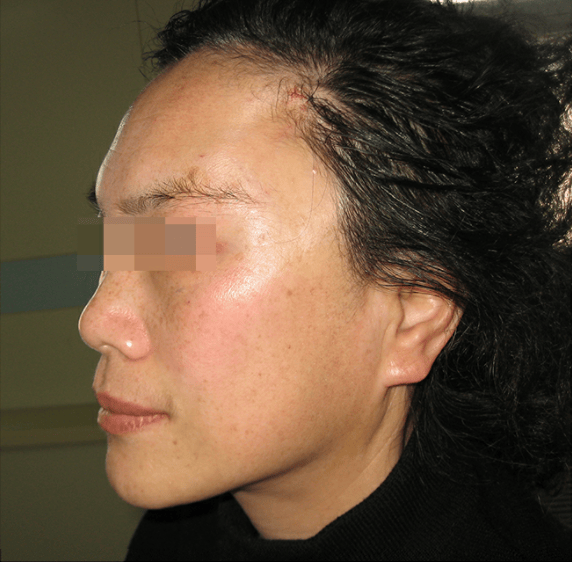 拉皮手术后耳朵会变形吗？