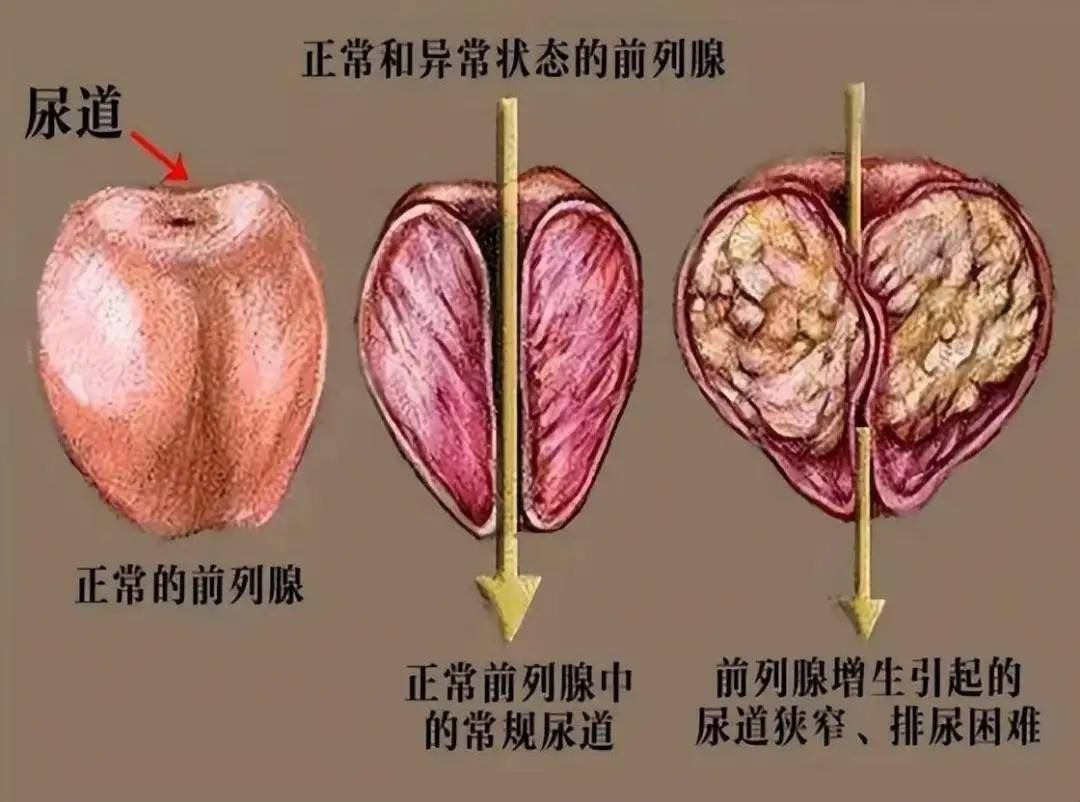 北京泌尿外科时京主任：从“栗子”到“鸡蛋”：认识前列腺增生，解码男性的“下水道”危机