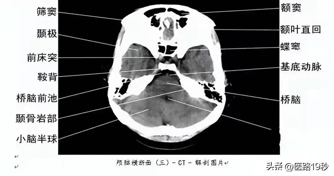 颅骨解剖图ct图片