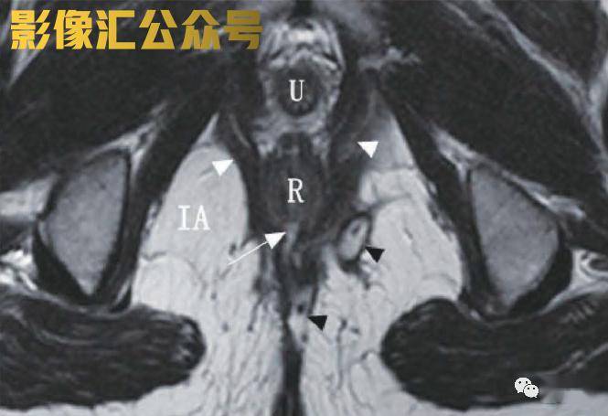 原發主管穿過恥尾肌(白色三角形)進入直腸(r) ,提示內口位置(白色箭頭