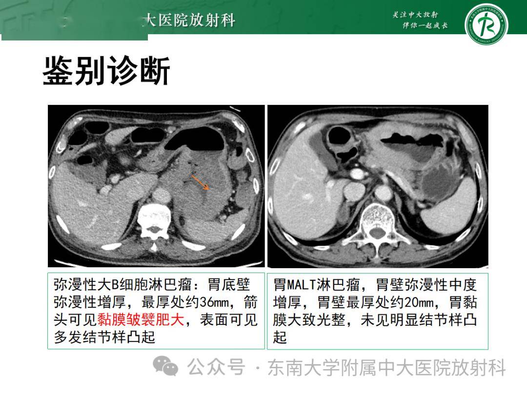 胃黏膜相關淋巴組織(malt)淋巴瘤_全網_影像_解剖圖