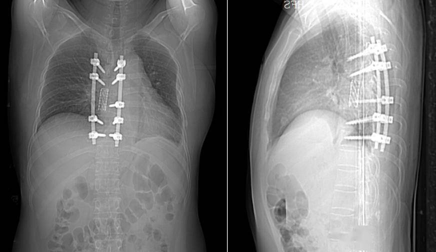 結合ct,mri,抽血化驗等檢查初步考慮診斷為胸椎結核並椎旁膿腫形成